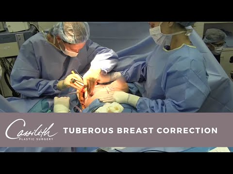 Tuberous Breast Specialist Dr. Lisa Cassileth Performs Corrective Surgery