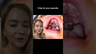 We love an expander!! Three tips to help #expander #braces