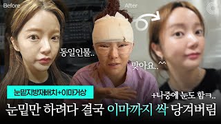 눈밑만 하려다 이마까지 싹 당겨버림ㅋ...