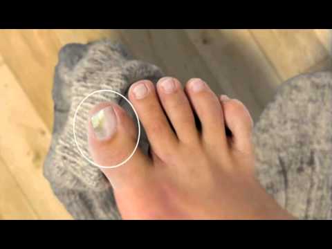 White kuko folk remedyo sa paggamot Foliated fingernail pagalingin