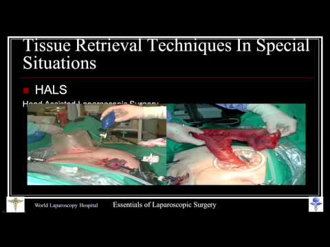 Técnica laparoscópica de recuperación de tejido