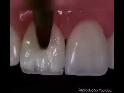 Restaurare dinte fracturat cu compozit/Restored fractured front tooth with composite!