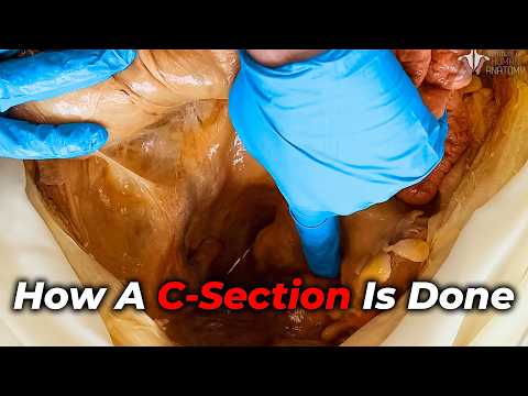 C-Section Explained: Every Surgical Layer Revealed