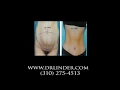 Beverly Hills Tummy Tuck