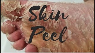 DIY Skin Peel | Healing Cracked Heels !!