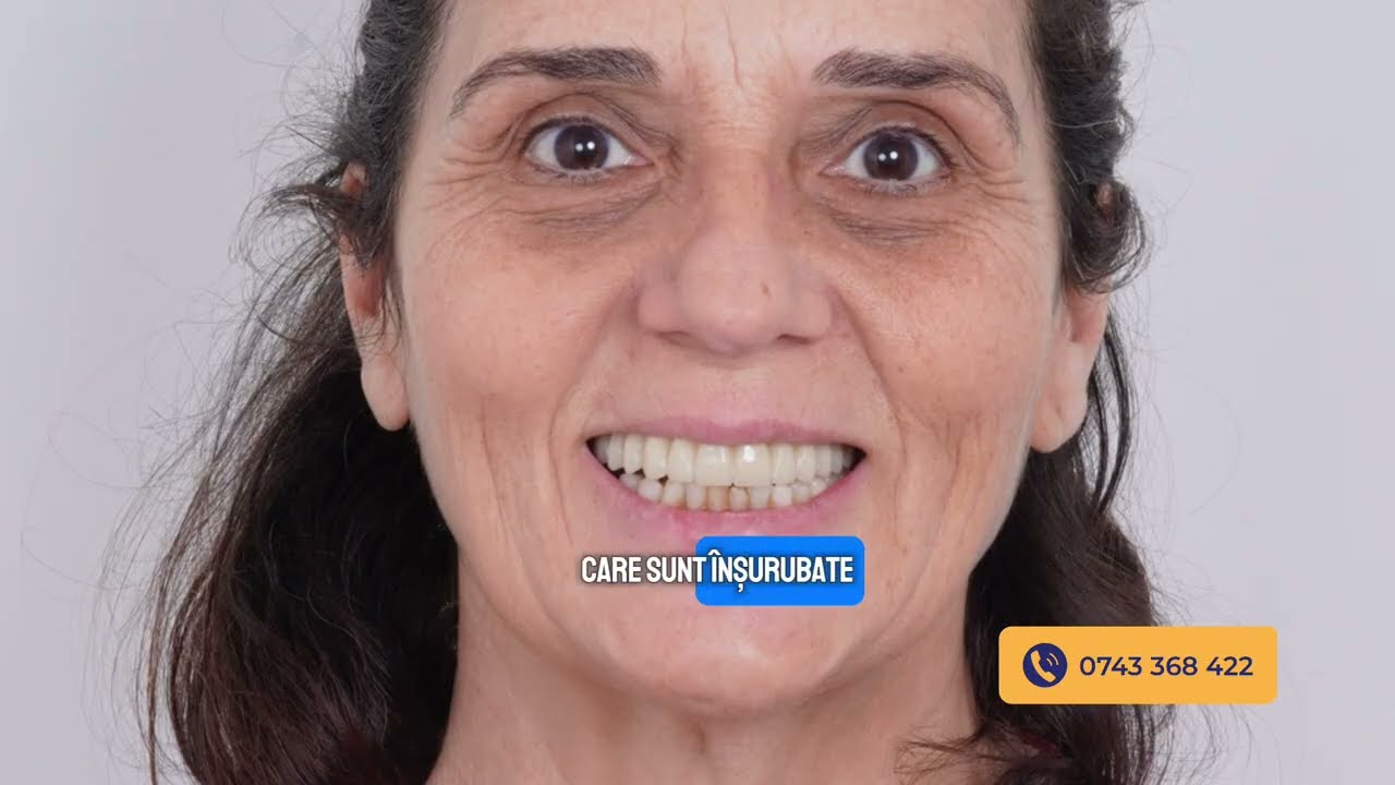 <div style="text-align: left; white-space: normal; overflow: hidden; display: -webkit-box; -webkit-line-clamp: 2; -webkit-box-orient: vertical; line-height: 1.3em;">Caz Clinic Uimitor: Zâmbet Stabil și Natural pe Implanturi | București Dentville</div>