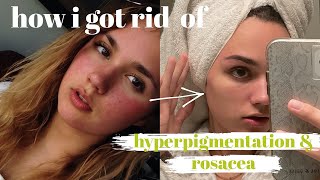 best ingredients for hyperpigmentation and rosacea | skincare routine for redness 2021