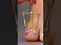 Ingrown toenail gadget hack #shorts