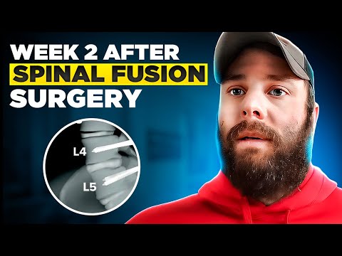 Beginning the Journey: What To Expect in Weeks 1 & 2 after L4-L5 Spinal Fusion Recovery