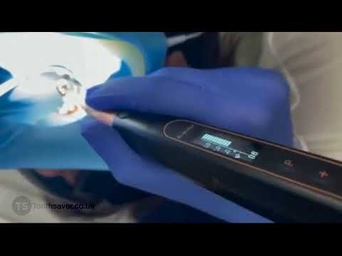 Video 1   Ai Motor Apex Locator mov 1