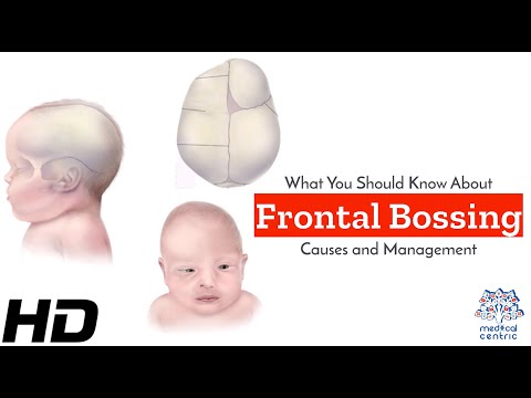 Hydrocephalus Causes Signs and Symptoms Diagnosis and Treatment