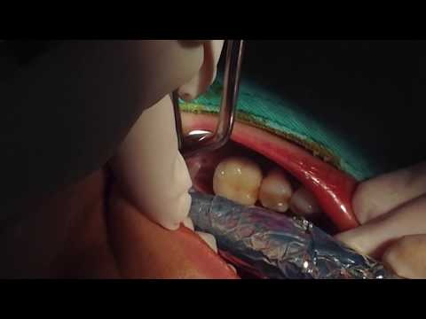 Assisted Implant Surgery with LIGHTMED's SAPPHIRE Laser