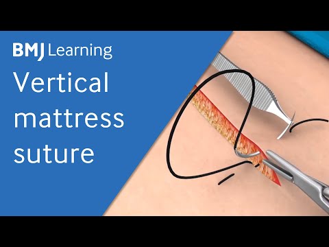 Vertical Mattress Suture | BMJ Learning