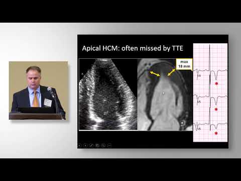 David Owens, MD, Diagnostic Evaluation of ECG Abnormalities Suggestive of Hypertrophic Cardiomyopath