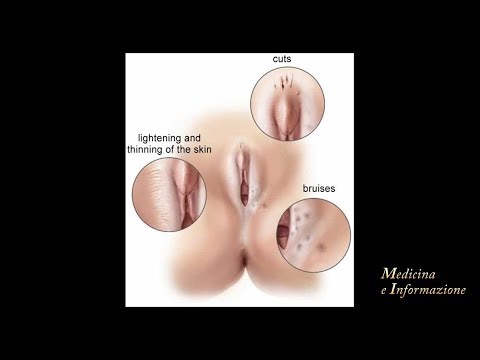 îndepărtați papiloma grodno cancer la plamani celule mici