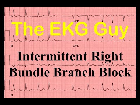 EKG/ECG - Intermittent Right Bundle Branch Block - Question 23.0 | The EKG Guy