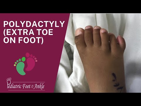 Polydactyly (ExtraToe On Foot)
