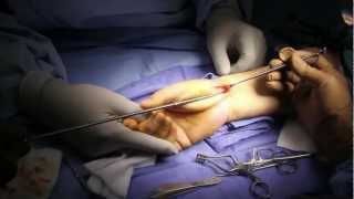 Trapezial Resection Arthroplasty