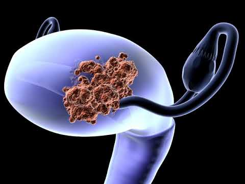 Prostate cancer genetic biomarkers