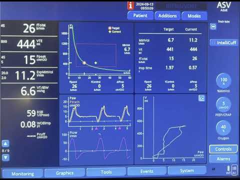 Adaptive Support Ventilation: A Case of High Minute Ventilation