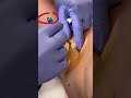 High pressure abscess POPPED! | 208SkinDoc