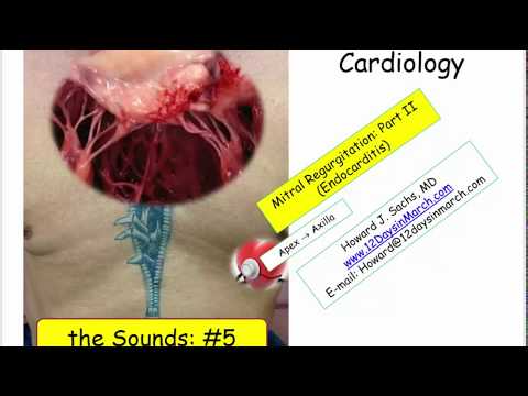 12DaysinMarch, Valvular Heart Disease #5, MR and Endocarditis for the USMLE Step One Exam