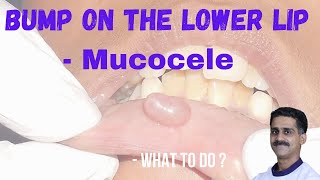 Mucocele - Bump on lower lip - what to do?