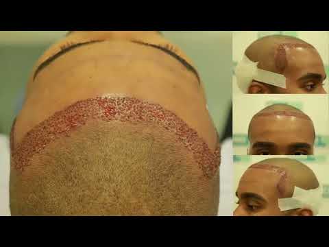 Afro Hair Transplant in Delhi Clinic With DHI-(Direct Hair Implantation) Technique