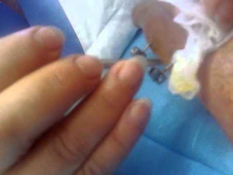 Dolore addominale con osteocondrosi Malattia del dellartrosi del ginocchio