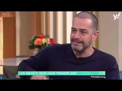 Lee Mead hair transplant