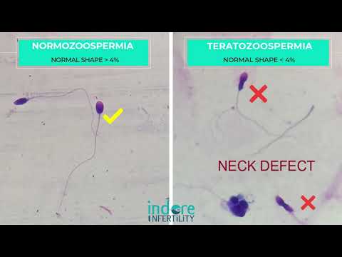 Teratozoospermia - Poor Morphology Sperms Comparison with Normal morhology sperms - Normozoospermia
