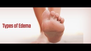 8 Types of Edema