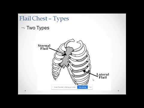 flail chest