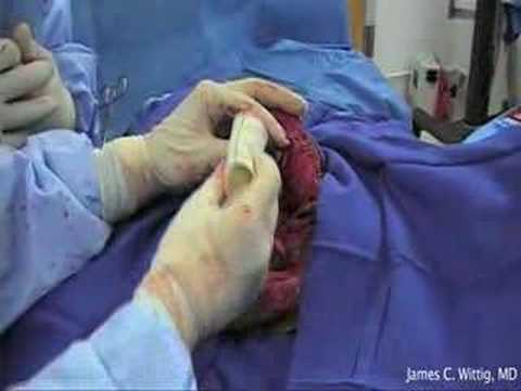 Całkowita proteza łopatki z powodu mięsaka Ewinga - część 6