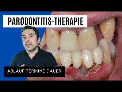 Parodontitistherapie / Zahnfleischbehandlung - Ablauf, Termine, Dauer nach den neuen Richtlinien