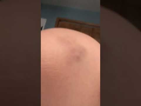 bad injury (got it from falling because of my pajamas)