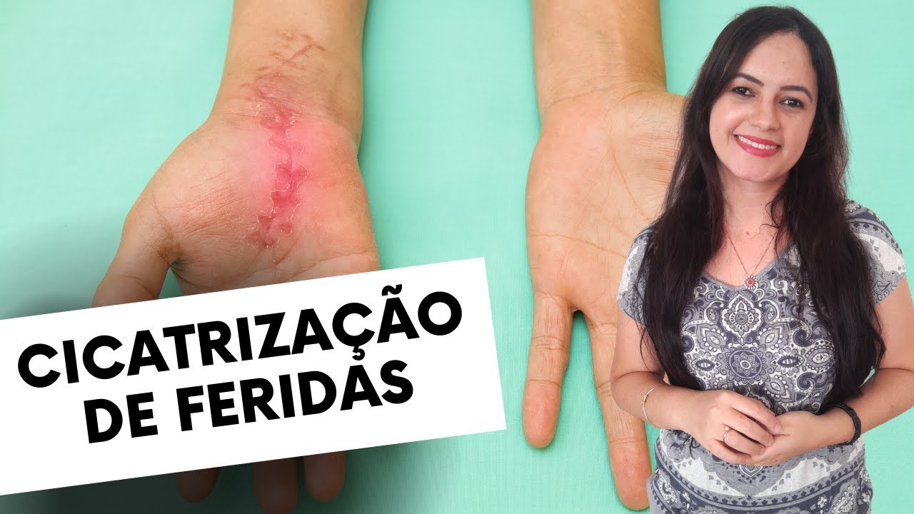 Cicatrização de Feridas (Tipos e Fases da Cicatrização Normal) - Profª Juliana Mello
