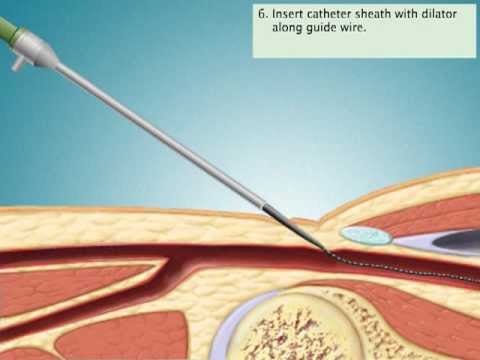 Cardiac Catheterization via Femoral Artery