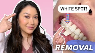 How to Remove WHITE SPOTS on Your Teeth | Dr. Joyce Kahng