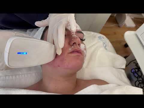 Lanreé Aesthetics Venus Viva Acne Scar Resurfacing