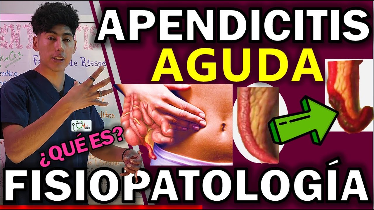 APENDICITIS AGUDA FISIOPATOLOGÍA | GuiaMed