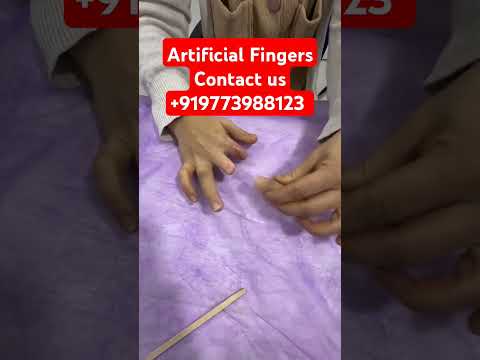 Best Silicone Artificial Fingers in India | World Class Silicone Finger Prosthesis | +919773988123