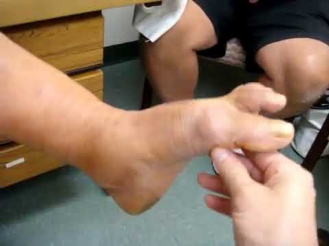 Towson Patient Has Surgery to Improve Pain in Foot and Knee