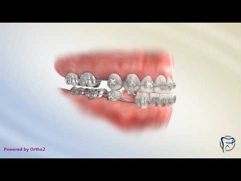 Fixing Class III Bite (Extractions)