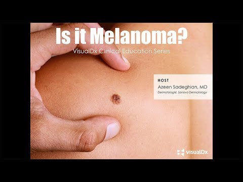 melanoma paraziták az egymás tetején élő paraziták