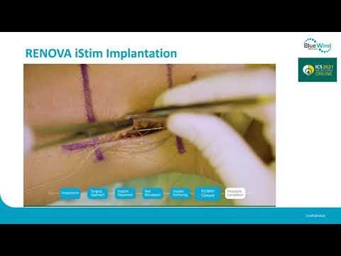 #23489 OASIS Pivotal Trial to Evaluate the Safety and Efficacy of the RENOVA iStim System™ for t...