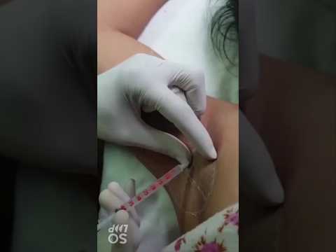 Botox treatment sweating treatment (पसीना)