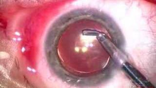 Cataract Extraction and Endothelial Keratoplasty