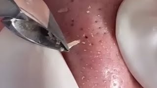 Download Lagu relax,Satisfying,nose blackheads,tweezers,acne treatment,鼻角栓,ピンセット,피지제거 043 Thumbnail