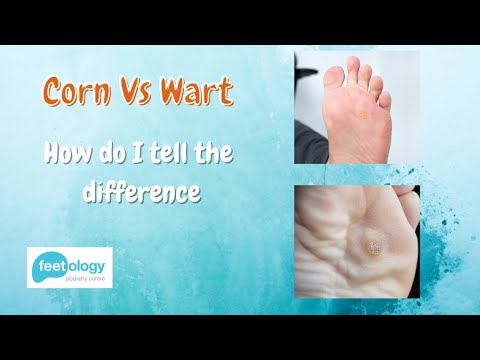 Corn Vs Wart - How Do I Tell The Difference